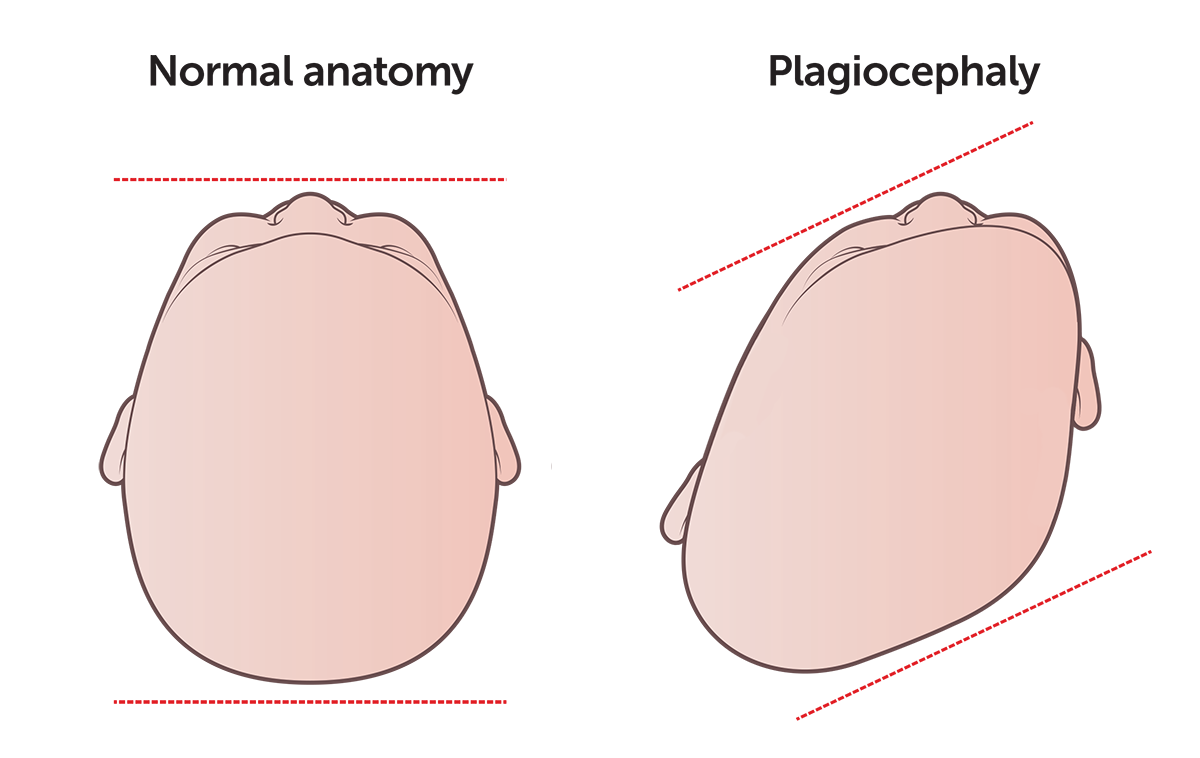 20241003_KHI_Plagiocephaly_Illustration_PlagiocephalyV2Protected